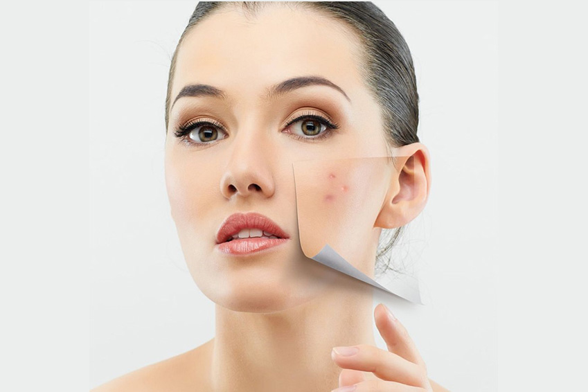 Best Acne Treatment Singapore Plan